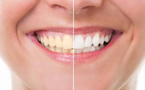 Axis Dental teeth whitening Therapy service